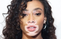 Winnie Harlow và hành trình vượt qua định kiến để tỏa sáng trên sàn diễn thời trang