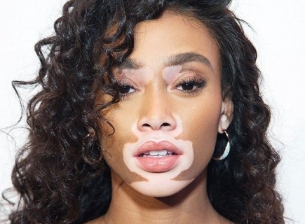 Winnie Harlow và hành trình vượt qua định kiến để tỏa sáng trên sàn diễn thời trang